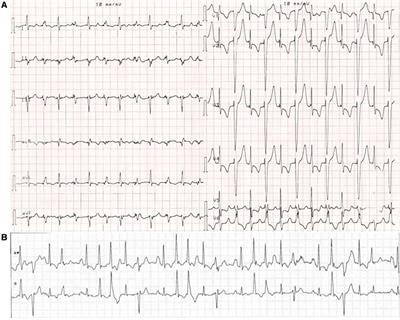 Multifocal ectopic purkinje-related premature contractions and related cardiomyopathy